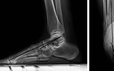 CLAI Patients with Subtle Cavus Foot: Is Calcaneal Osteotomy an Essential Procedure?