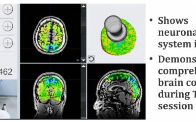Application Of Transcranial Pulse Stim in Rehab: Pain Management in Knee Osteoarthritis