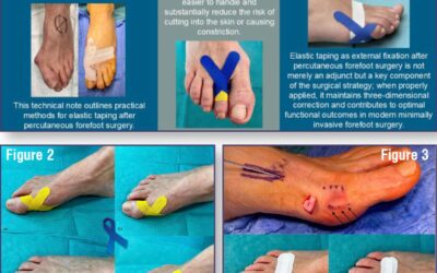 Elastic Taping of Toes after Percutaneous Forefoot Surgery: Technical Tip