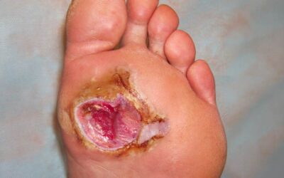Foot To Fatality: Alarming Outcomes Following Acute Diabetic Foot Infections 