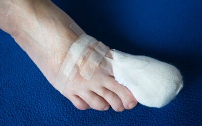 Ewing Sarcoma of The Great Toe: A Rare Case Report
